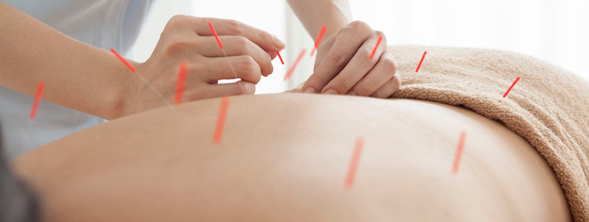 Acupunctuur bij lage rugpijn