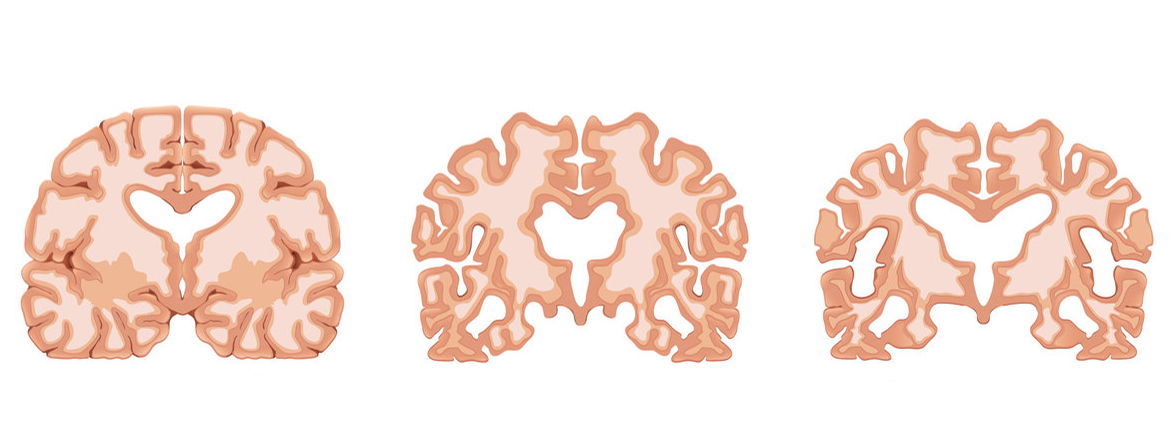 Mediterrane versus westerse voeding op beginnende dementie