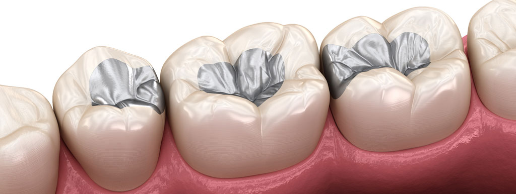 Amalgaam en kwik in het bloed