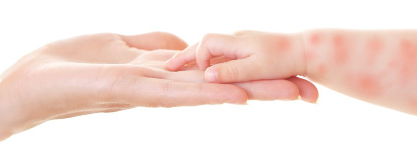 Vitamine D tegen eczeem