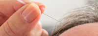 Acupunctuur en acupressuur kunnen pijn bij kanker verminderen
