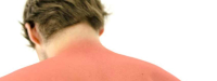 Vitamine D dempt ontsteking door zonnebrand