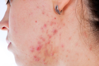 Vetzuren tegen acne