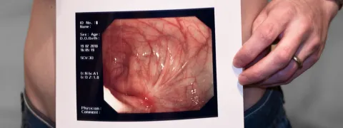CLA tegen crohn