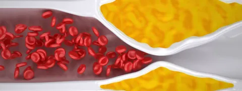 Vitamine K2 verlaagt kans op perifere atherosclerose