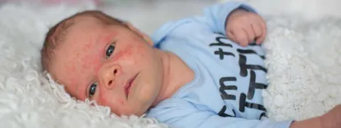 Vitamine D-suppletie bij eczeem belangrijk voor kinderen