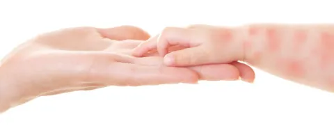 Vitamine D tegen eczeem