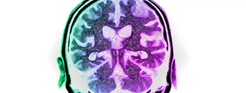 Microben oorzaak van alzheimer?