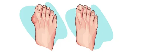 Mediterrane voeding lijkt gunstig bij jicht