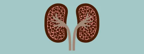 Geen risico op nierstenen door hoge dosis vitamine D