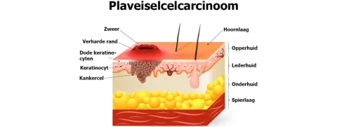 Vitamine A verkleint mogelijk kans op plaveiselcelcarcinoom