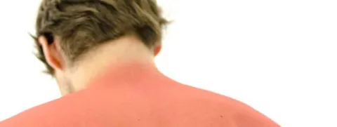 Vitamine D dempt ontsteking door zonnebrand