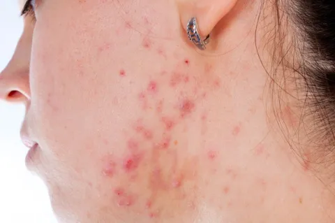 Vetzuren tegen acne