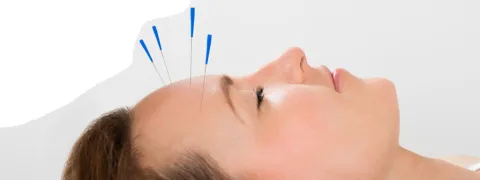 Acupunctuur vermindert menopauzale klachten