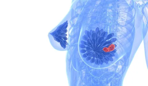 Multivitaminen bij behandeling van borstkanker