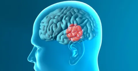 Co-enzym Q10 en parkinson: dosisstudie