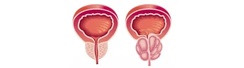 Melatonine voor lager risico prostaatkanker