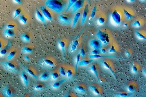 Metaboloom van lycopeen bij prostaatpatiënten