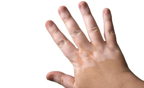 Hoge dosis vitamine D als medicijn tegen vitiligo en psoriasis