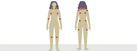 Cognitieve, fysieke en meditatieve training tegen fibromyalgie