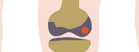 Artrose