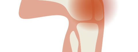 artrose