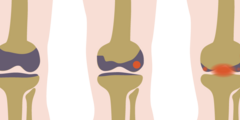 Artrose