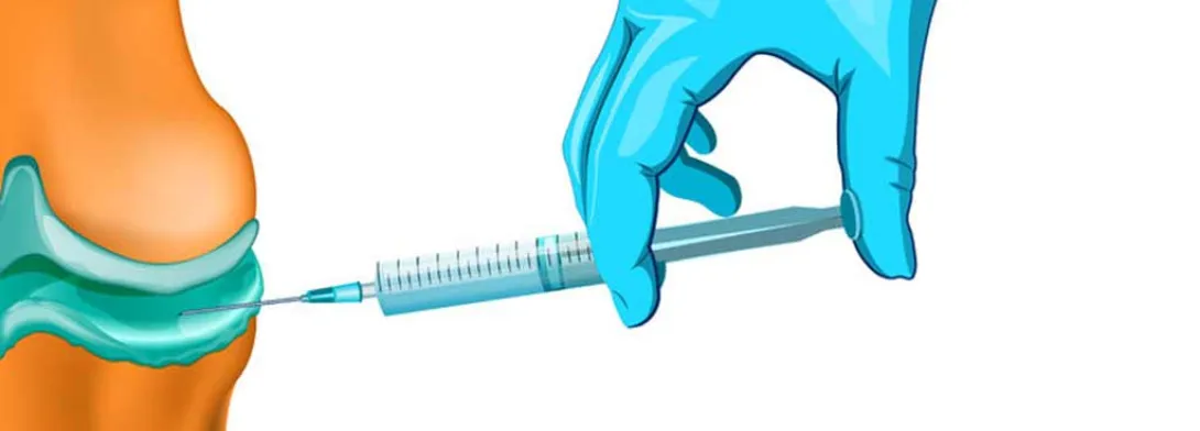 Knieartrose: ozontherapie evenwaardig aan hyaluronzuur