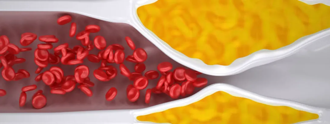 Vitamine K2 verlaagt kans op perifere atherosclerose