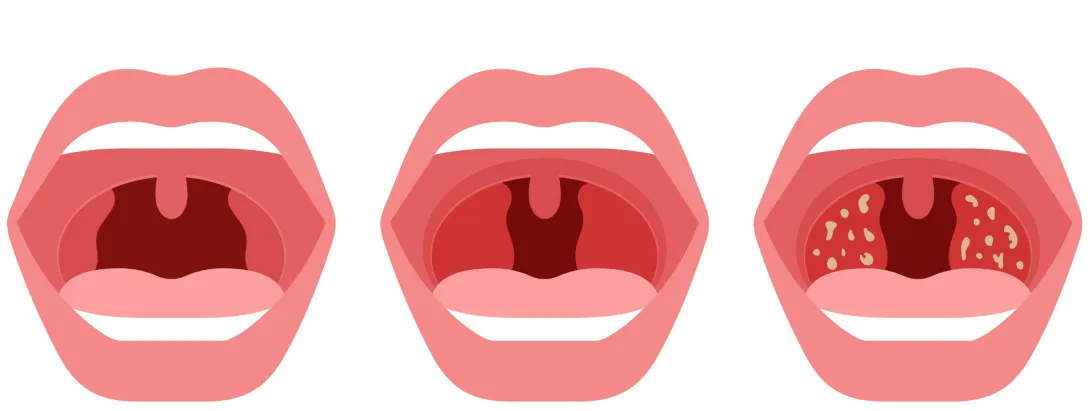 Verzorg je amandelen met natuurlijke middelen