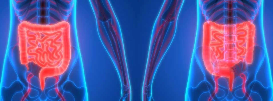 Inname van vetten lijkt niet geassocieerd met colorectale kanker