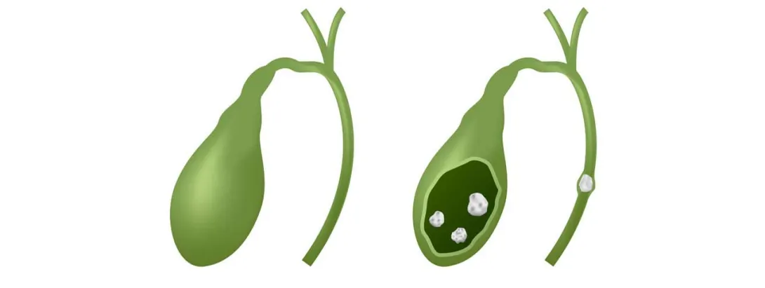 Tekort aan vitamine E risicofactor voor galstenen
