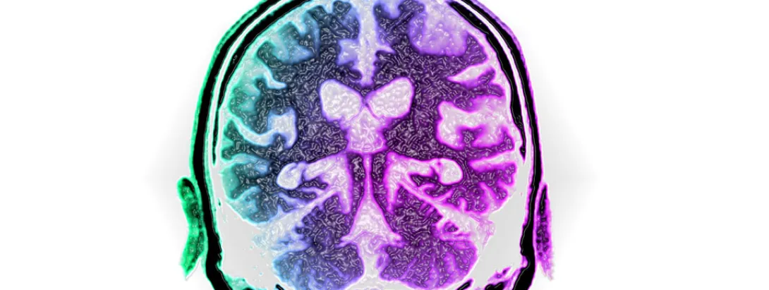 Microben oorzaak van alzheimer?