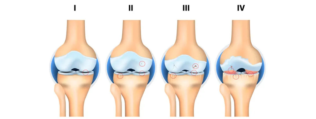 Injecties met hyaluronzuur en 'DNA' tegen knieartrose