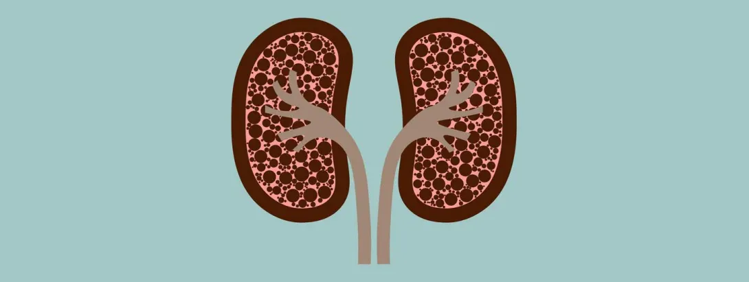 Geen risico op nierstenen door hoge dosis vitamine D