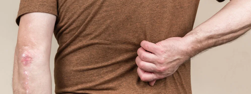 Psoriasis, hart- en vaatziekten en trombose