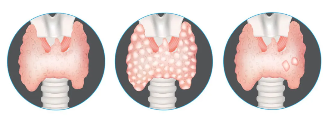 Curcumine, boswellia en spirulina in de strijd tegen schildklierknobbeltjes