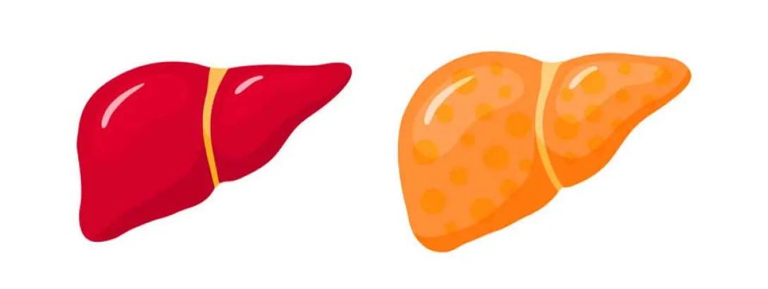 Waarom leververvetting ook bij slanke mensen voorkomt