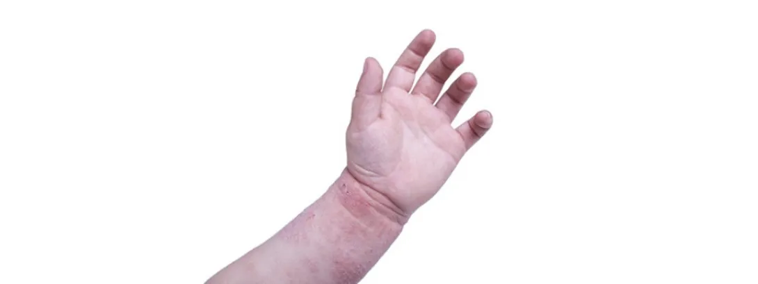 Probiotica tegen kindereczeem