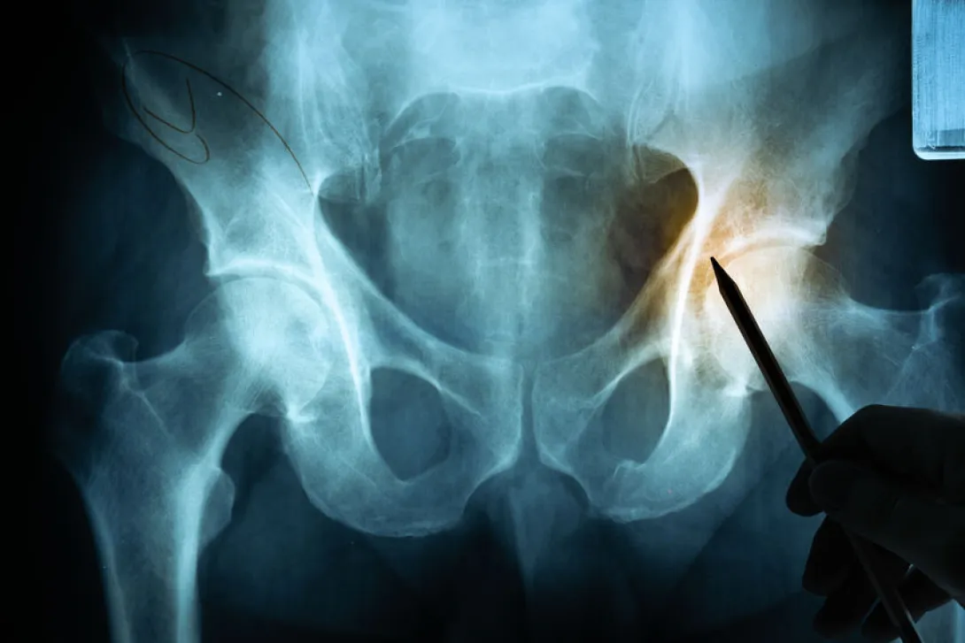 Grotere kans op heupfracturen bij hoge doses vitamine B6 en B12