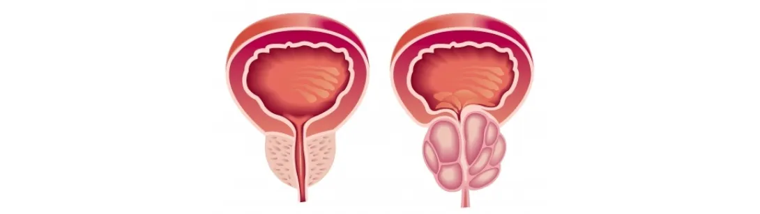 Melatonine voor lager risico prostaatkanker